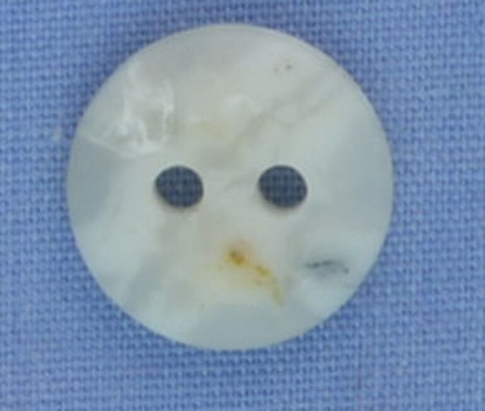 11mm Mottled White 2 Hole Button (x 4 buttons)
