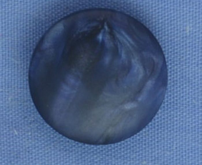 15mm Mottled Navy Blue Shank Button (per button)